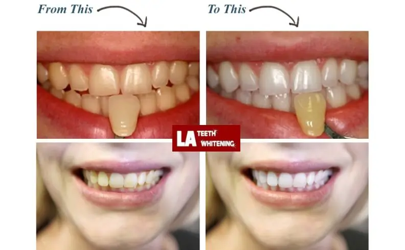 Is Laser Whitening More Expensive Than Standard Whitening—And Is It Worth It Middlesex