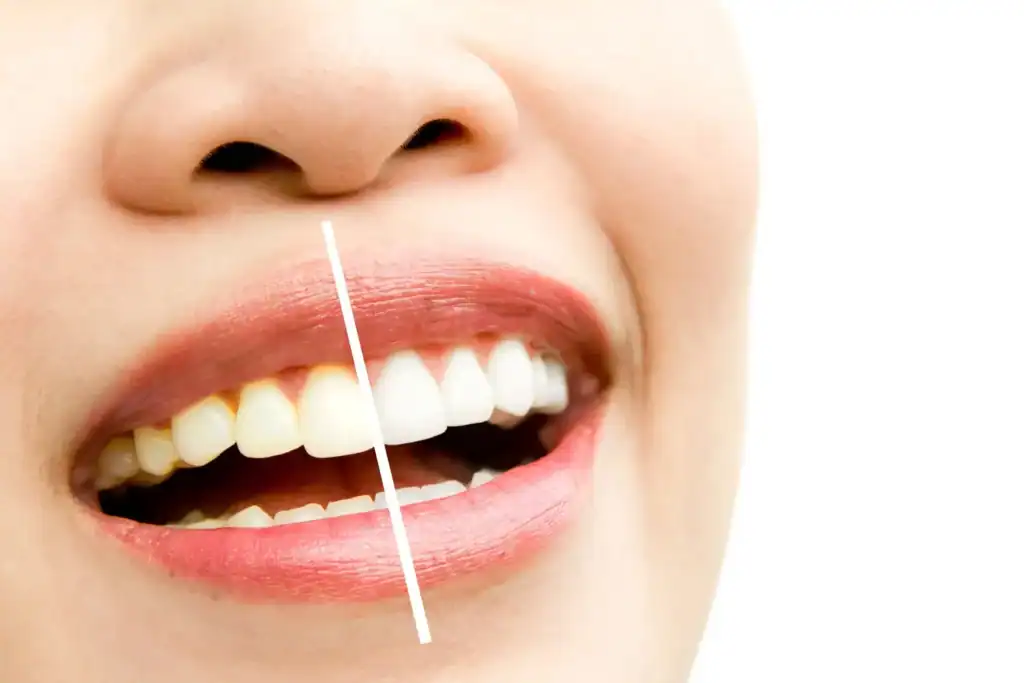 What’s the Difference Between Standard and Laser Teeth Whitening Middlesex